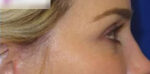 Eyelid Lift