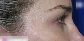 Eyelid Lift Case 16480 Before Photo Eyelid Lift