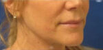 FACEology Lift / Neck Lift