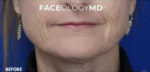 FACEology Lift / Neck Lift