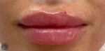 Lip Augmentation