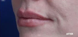 Lip Augmentation