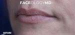 Lip Augmentation