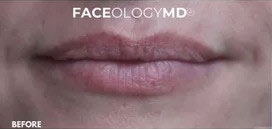 Lip Augmentation