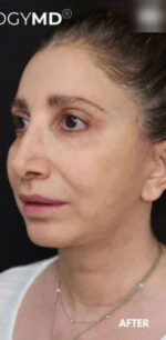 Lip Augmentation