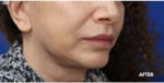 Lip Augmentation
