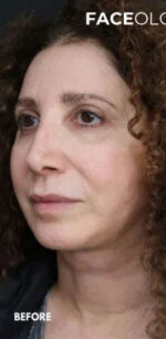 Lip Augmentation