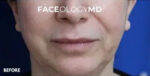 Lip Augmentation
