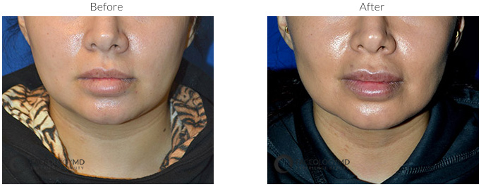 Buccal Fat Reduction Before & After