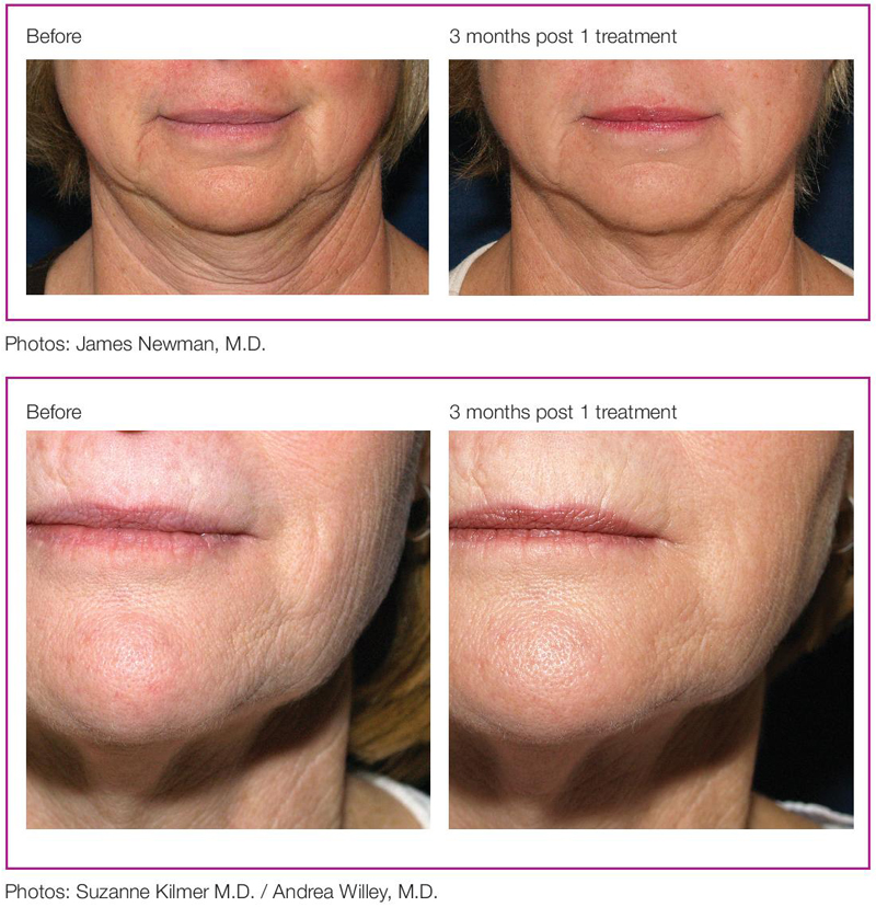 Profound® Before & After Results