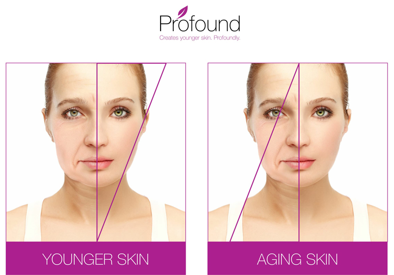Younger vs. Aging Skin Infogprahic