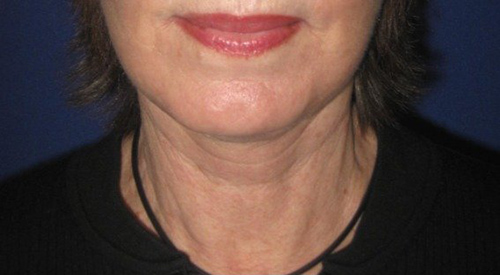 Neck-lift