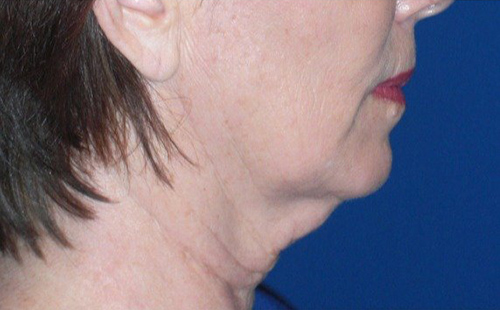 Neck-lift