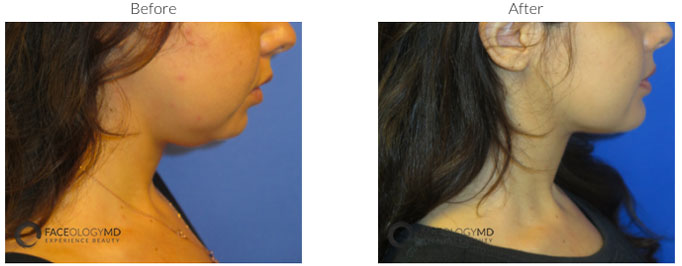 Chin Augmentation Before & After