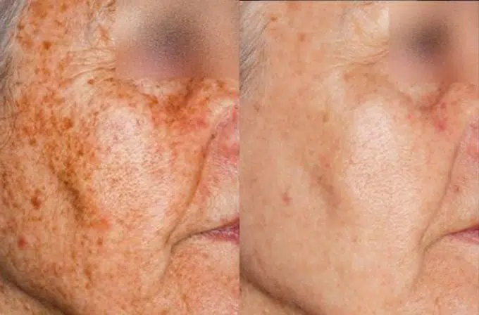 ipl photofacial before and after photo by faceology md in newport beach ca