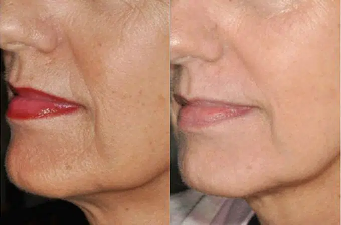 ipl photofacial before and after photo by faceology md in newport beach ca