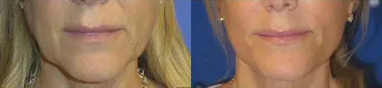 faceology lift neck Lift before and after photo by faceology md in newport beach ca