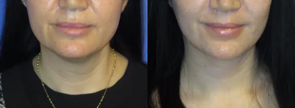 faceology lift neck Lift before and after photo by faceology md in newport beach ca