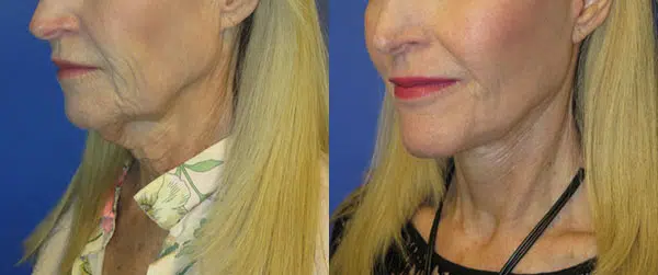 faceology lift neck Lift before and after photo by faceology md in newport beach ca