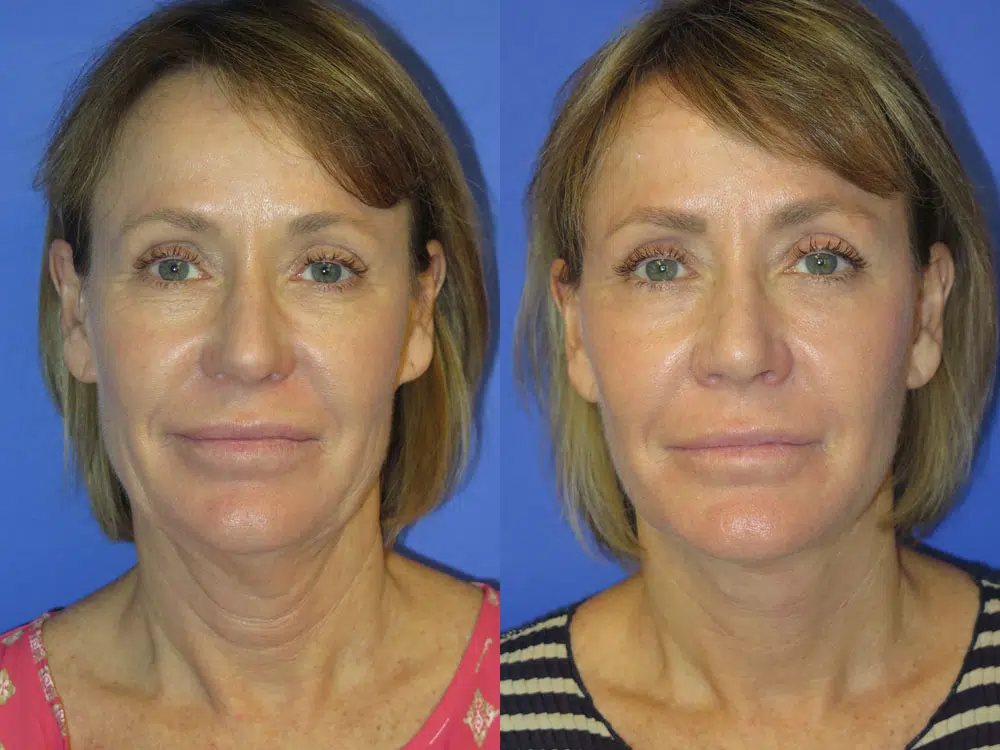 faceology lift neck Lift before and after photo by faceology md in newport beach ca