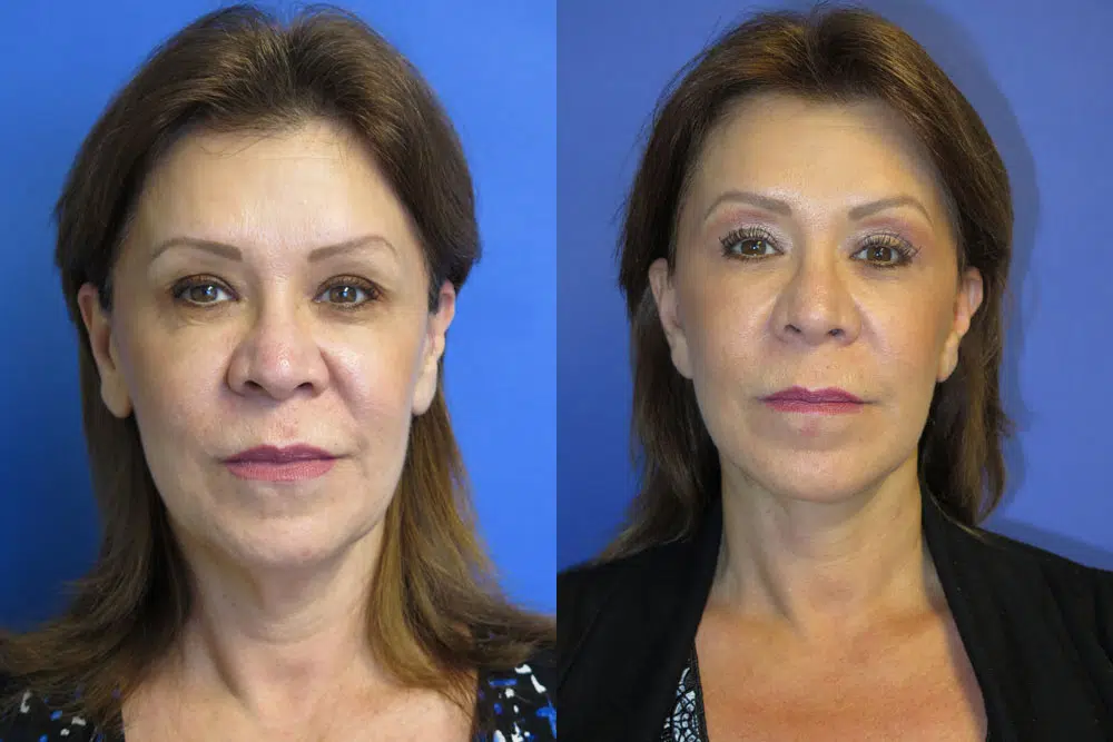 faceology lift neck Lift before and after photo by faceology md in newport beach ca