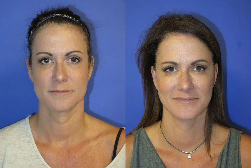 faceology lift neck Lift before and after photo by faceology md in newport beach ca