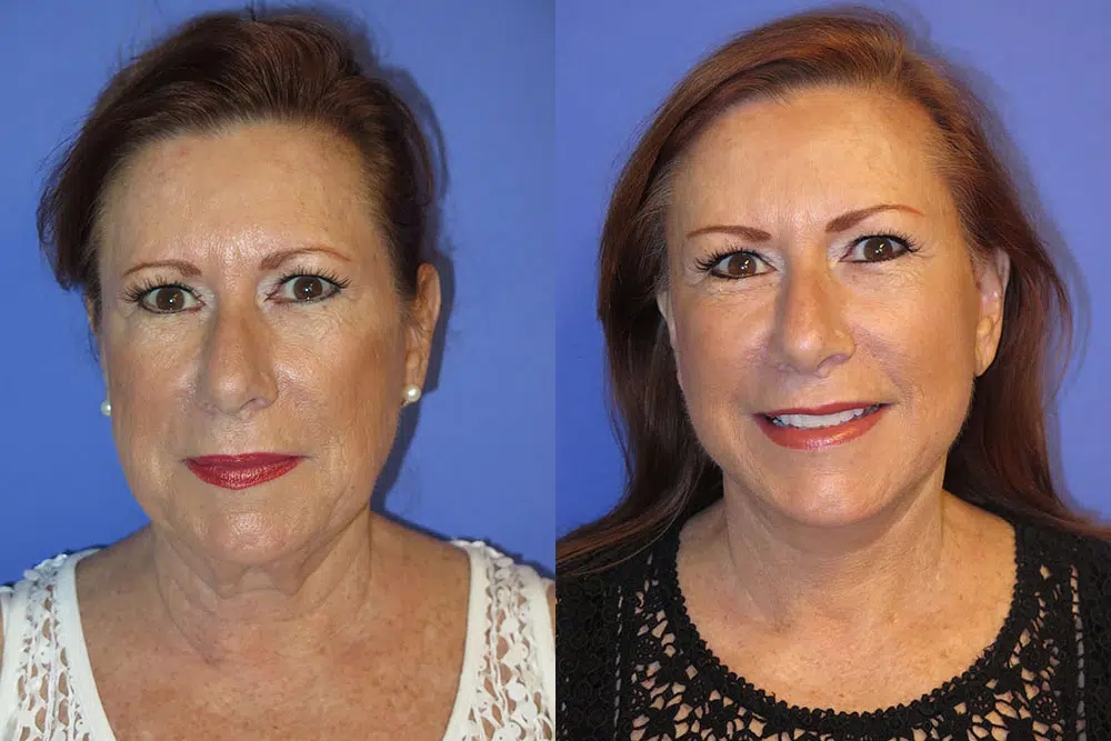 faceology lift neck Lift before and after photo by faceology md in newport beach ca