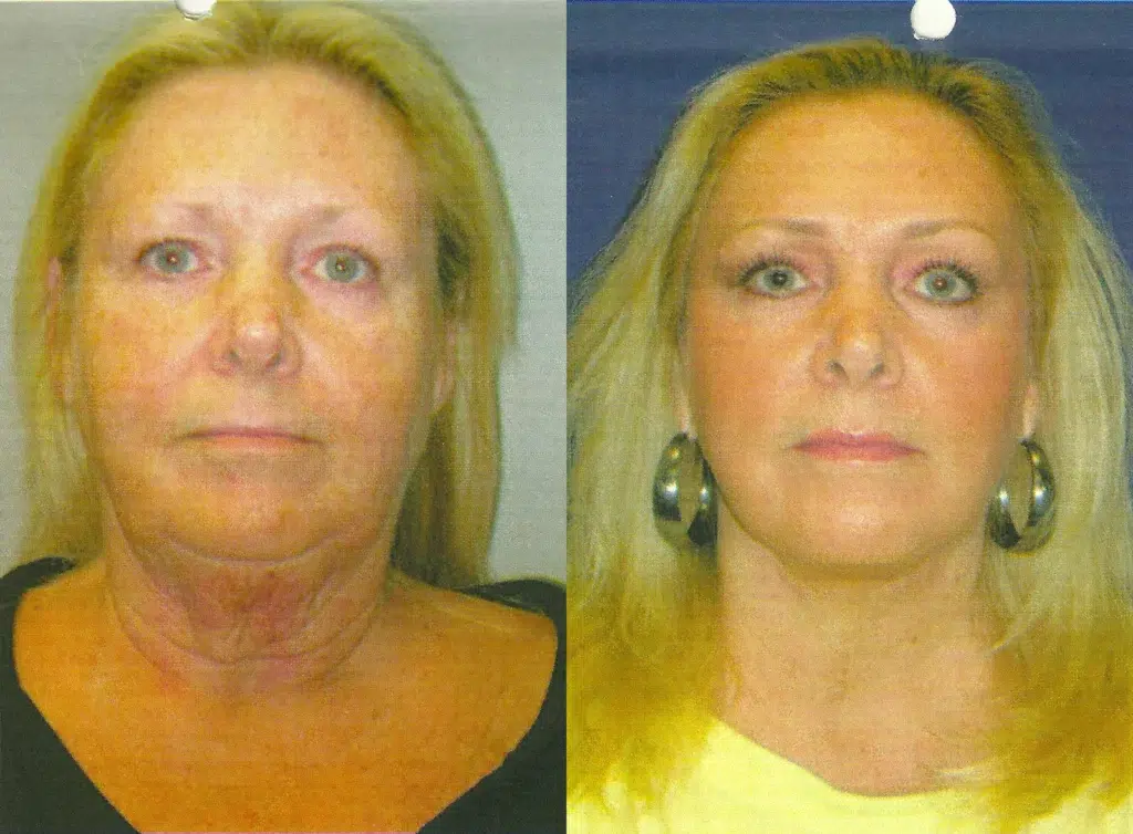 faceology lift neck Lift before and after photo by faceology md in newport beach ca