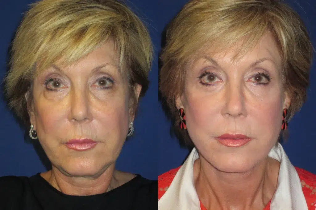 faceology lift neck Lift before and after photo by faceology md in newport beach ca