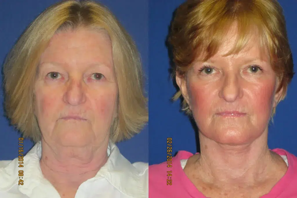 faceology lift neck Lift before and after photo by faceology md in newport beach ca