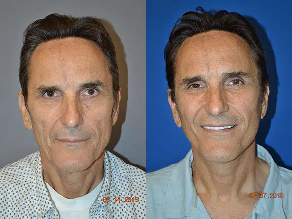 faceology lift neck Lift before and after photo by faceology md in newport beach ca