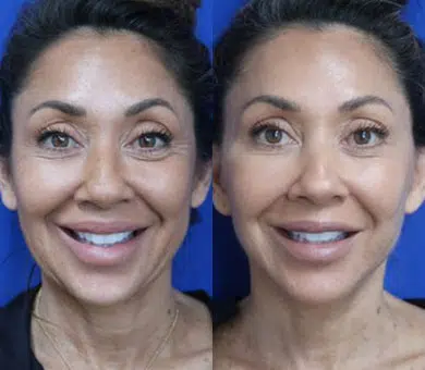 faceology lift neck Lift before and after photo by faceology md in newport beach ca