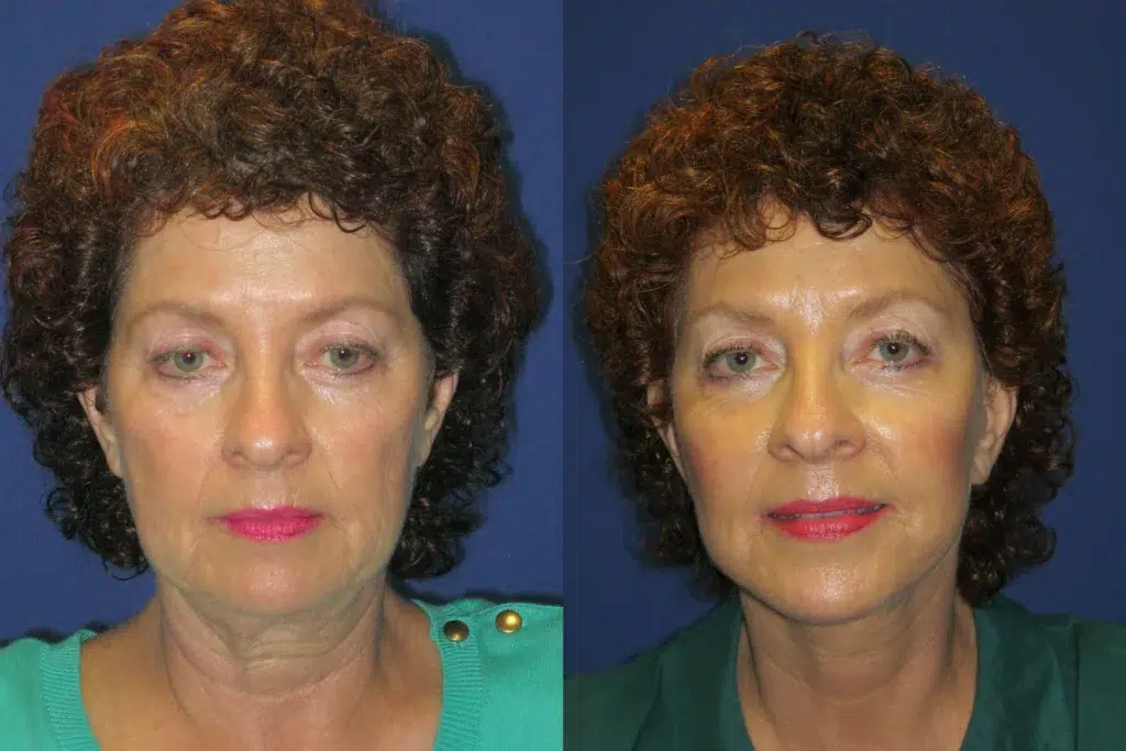 faceology lift neck Lift before and after photo by faceology md in newport beach ca