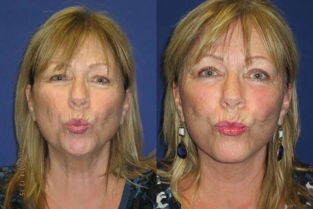 faceology lift neck Lift before and after photo by faceology md in newport beach ca