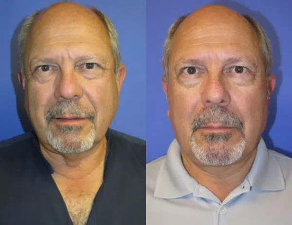 faceology lift neck Lift before and after photo by faceology md in newport beach ca