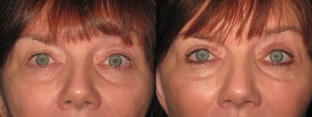 faceology lift neck Lift before and after photo by faceology md in newport beach ca