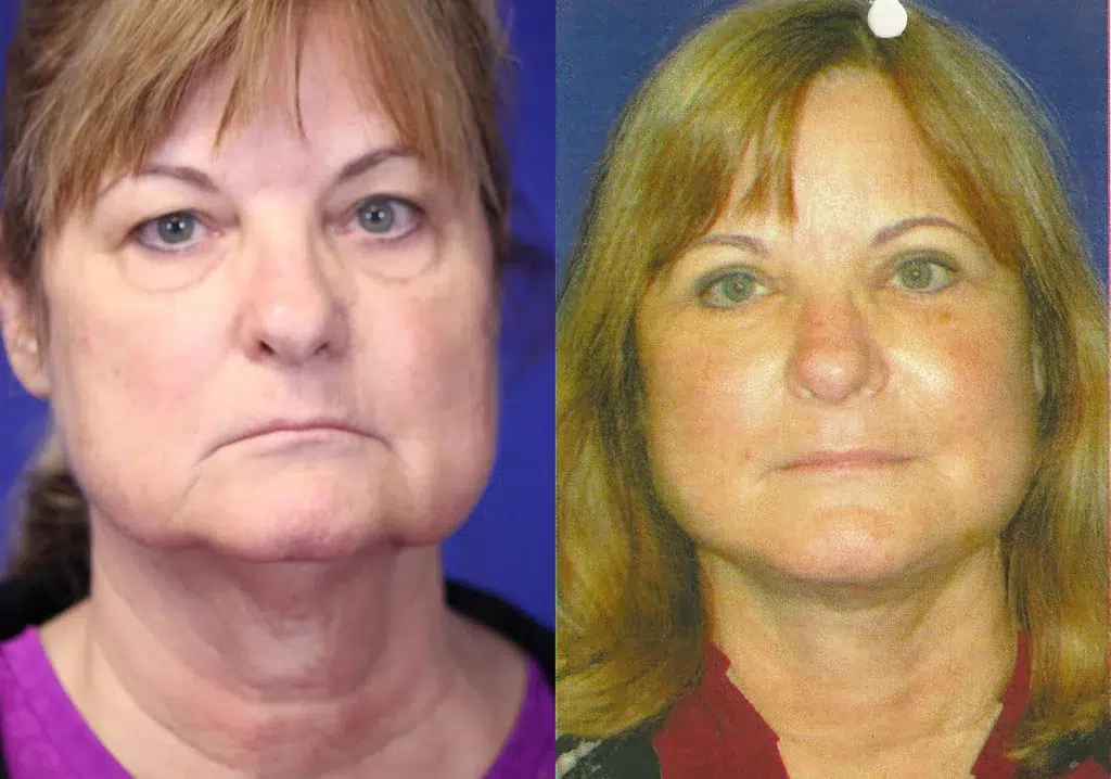 faceology lift neck Lift before and after photo by faceology md in newport beach ca
