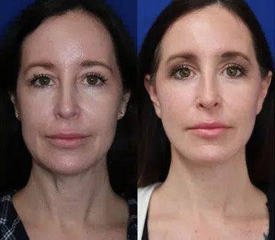 faceology lift neck Lift before and after photo by faceology md in newport beach ca