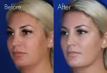 faceology lift neck Lift before and after photo by faceology md in newport beach ca