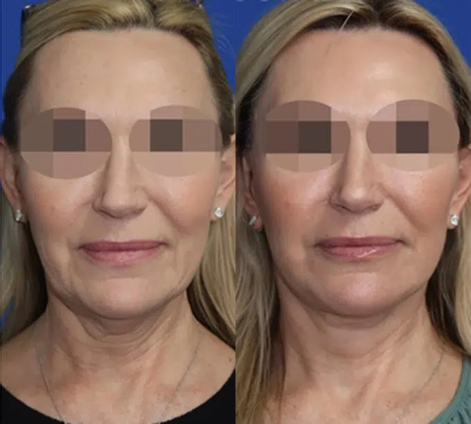 faceology lift neck Lift before and after photo by faceology md in newport beach ca