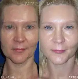 faceology lift neck Lift before and after photo by faceology md in newport beach ca