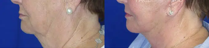 faceology lift neck Lift before and after photo by faceology md in newport beach ca