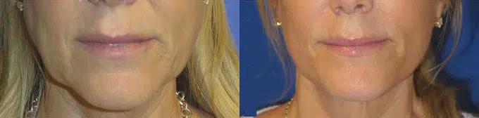 faceology lift neck Lift before and after photo by faceology md in newport beach ca