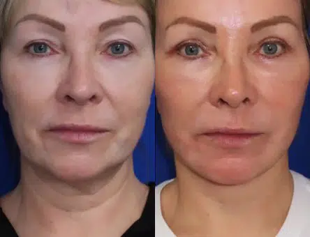 faceology lift neck Lift before and after photo by faceology md in newport beach ca