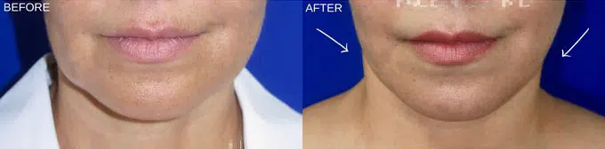 faceology lift neck Lift before and after photo by faceology md in newport beach ca