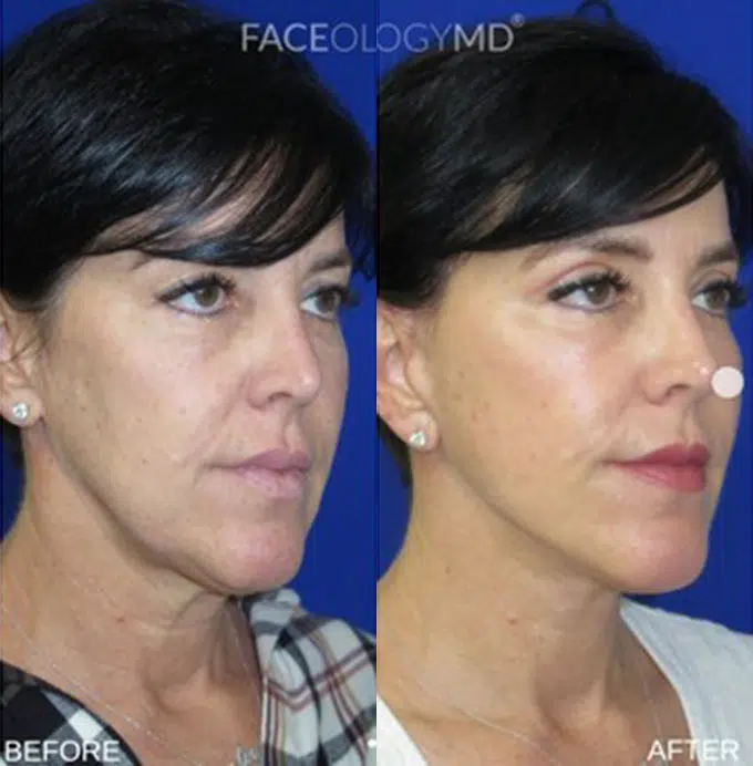 faceology lift neck Lift before and after photo by faceology md in newport beach ca