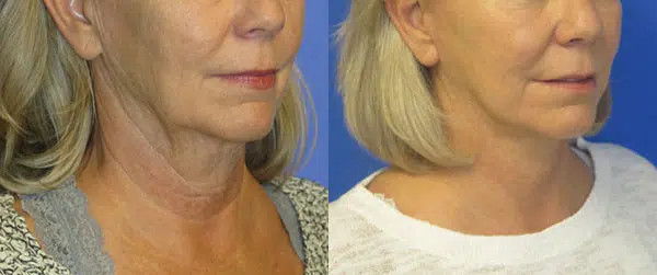 faceology lift neck Lift before and after photo by faceology md in newport beach ca