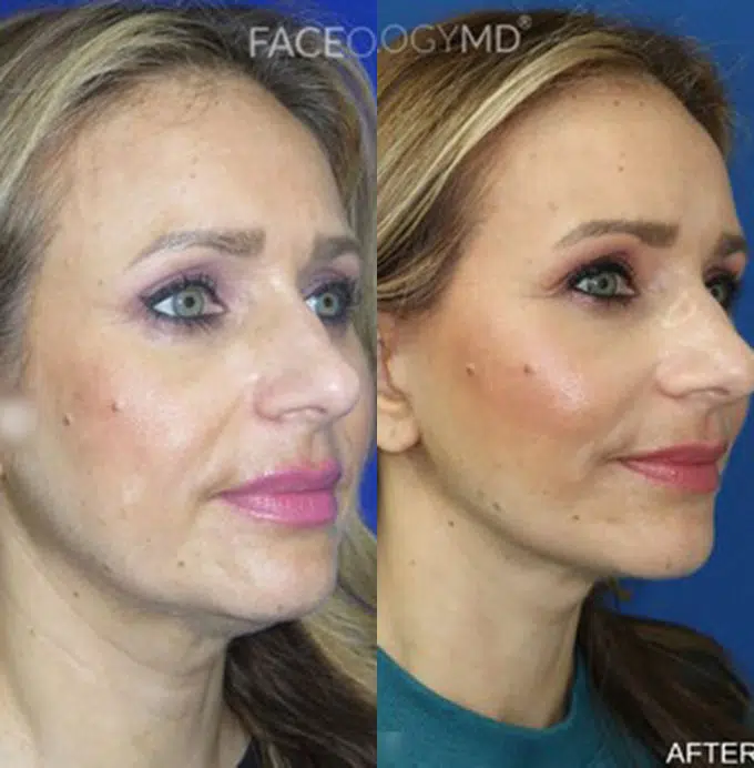faceology lift neck Lift before and after photo by faceology md in newport beach ca