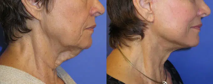 faceology lift neck Lift before and after photo by faceology md in newport beach ca