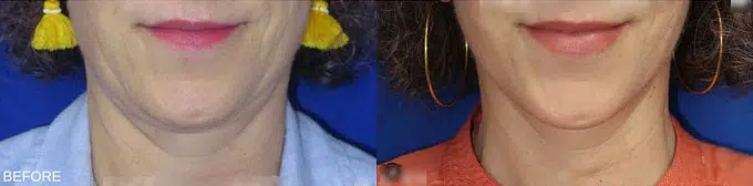 faceology lift neck Lift before and after photo by faceology md in newport beach ca
